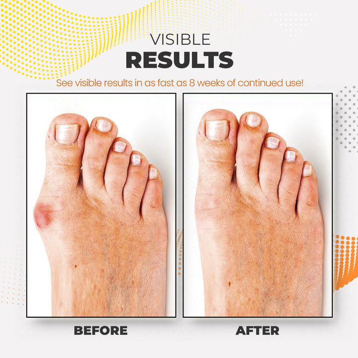 Feetin™ Bunion Relief Fit Patch